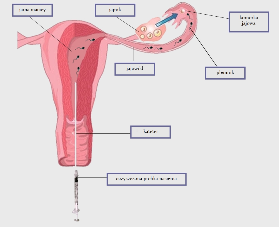 Schemat inseminacji domacicznej.