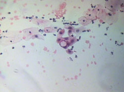 Chlamydia trachomatis w obrazie cytologicznym.